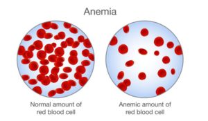 Anemia