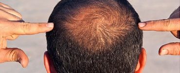 home remedies for hair loss