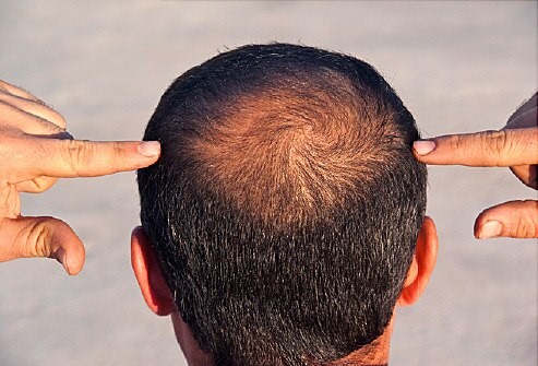 home remedies for hair loss