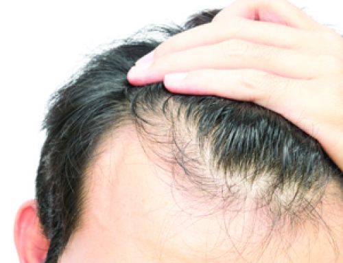 Causes of Baldness
