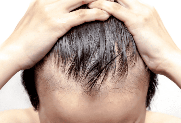 Male Pattern Baldness Vs Alopecia