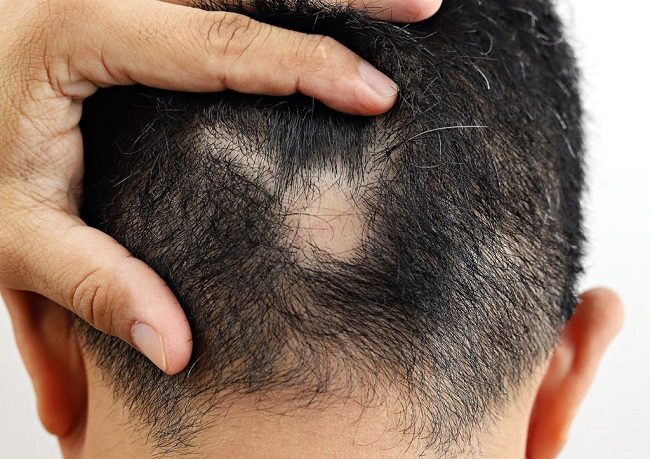 Male Pattern Baldness Vs Alopecia