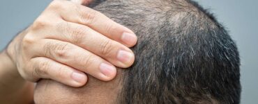 Hair loss and its impact on health
