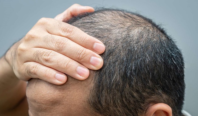 Hair loss and its impact on health